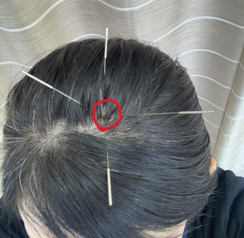 イボへの鍼灸治療